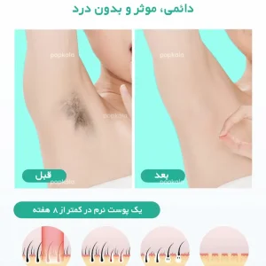 تاثیر دستگاه لیزر مو